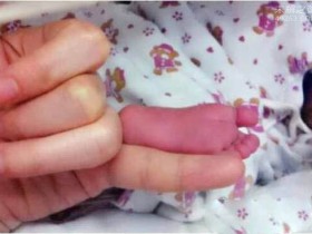 世界上最小的婴儿阿米利娅・泰勒:出生仅280克(今年14岁)