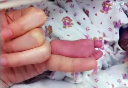 世界上最小的婴儿阿米利娅・泰勒:出生仅280克(今年14岁)